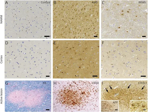 Investigadores de la REEM encuentran un posible papel de los astrocitos activados en la progresión de la EM